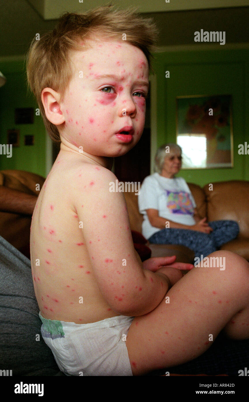 Young child with bad case of Chickenpox. Stock Photo