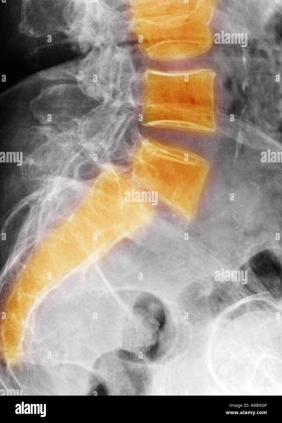 Lumbar spine xray showing a grade II anterolisthesis of L5 on S1 Stock ...