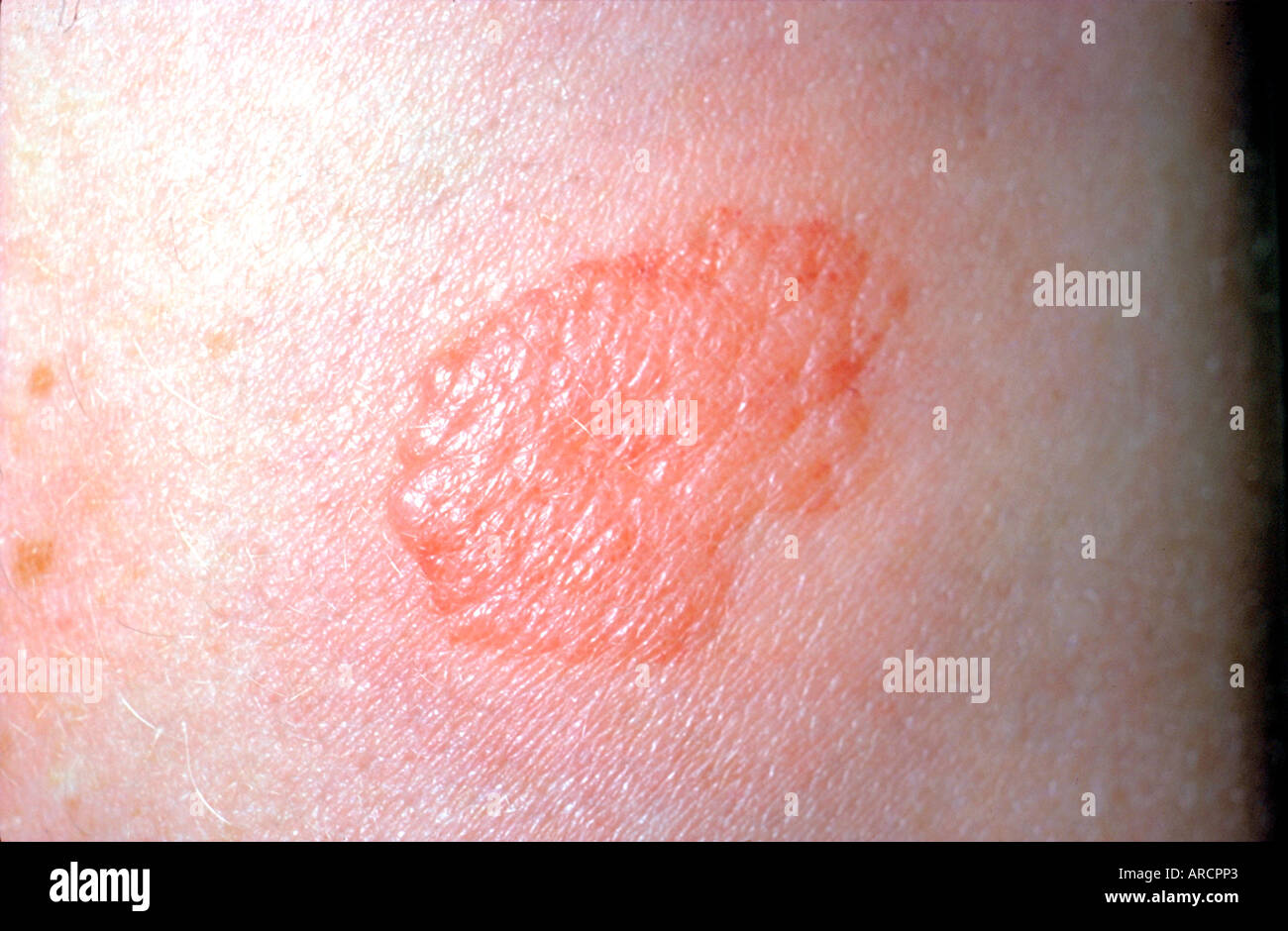 A photograph of a reaction to the tuberculin skin test, called a mantoux reaction. Stock Photo