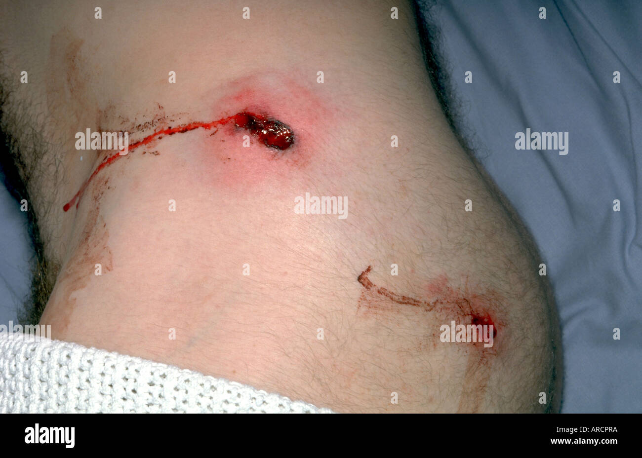 A photograph showing an entry and exit wound from a gunshot injury. Stock Photo