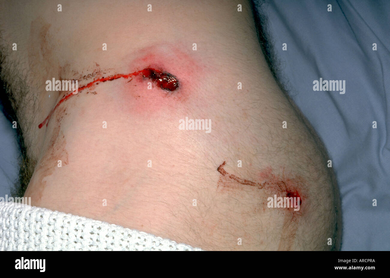 gunshot exit wound