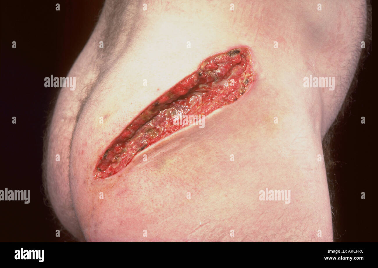 A photograph showing the tract between an entry and exit wound from a gunshot injury Stock Photo