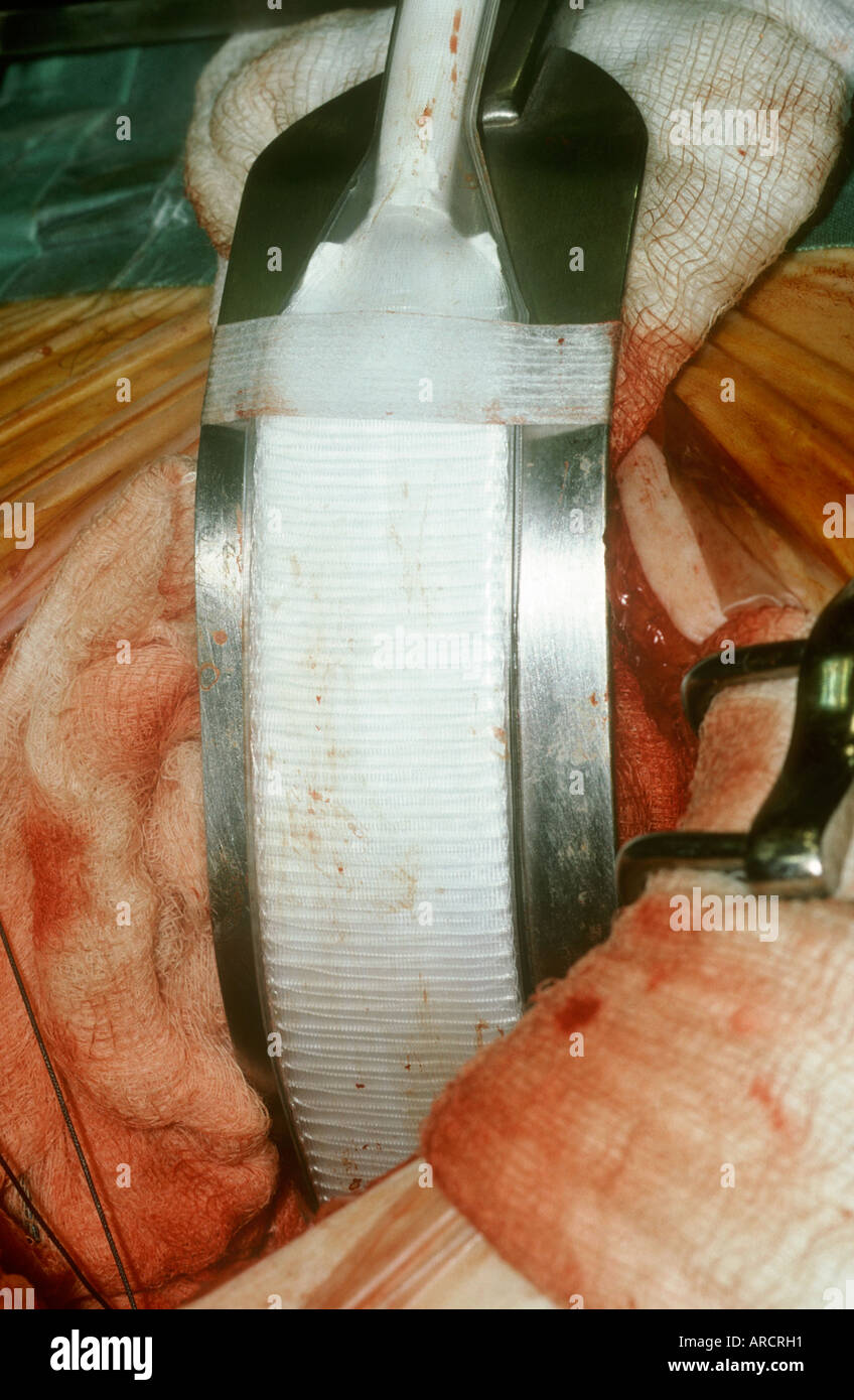 A photograph showing surgery for cancer of the prostate. Seen here is a retractor in the wound. Stock Photo