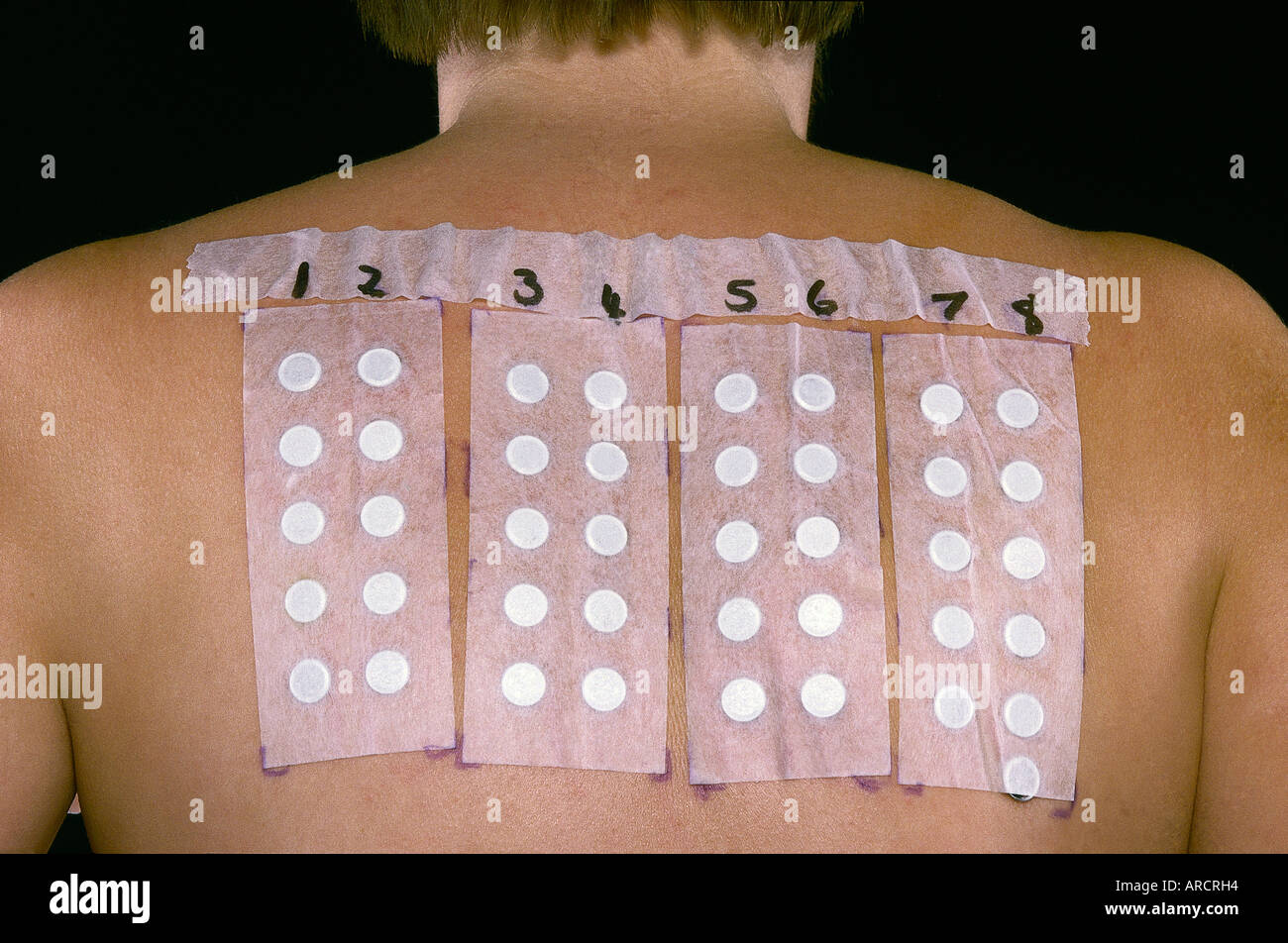 A photograph of patch testing for allergies Stock Photo