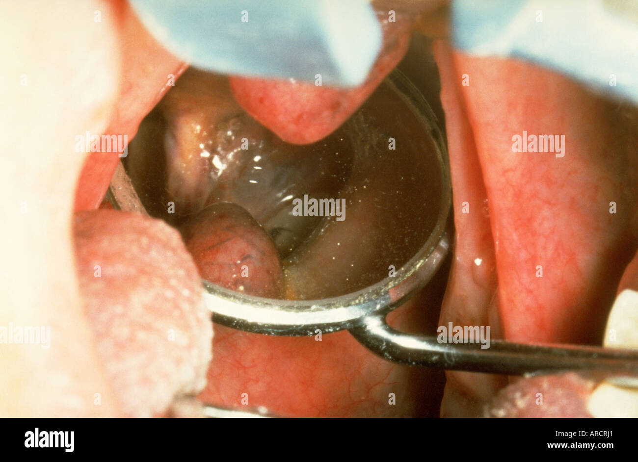 Tooth Extraction Food Getting In Hole Tooth Extraction Food Getting In Hole