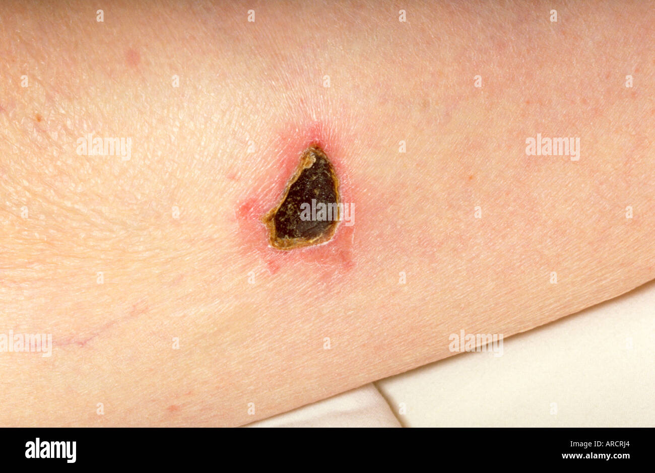 Bullous or blistering drug eruptions are among the most serious types of adverse drug reactions. Stock Photo