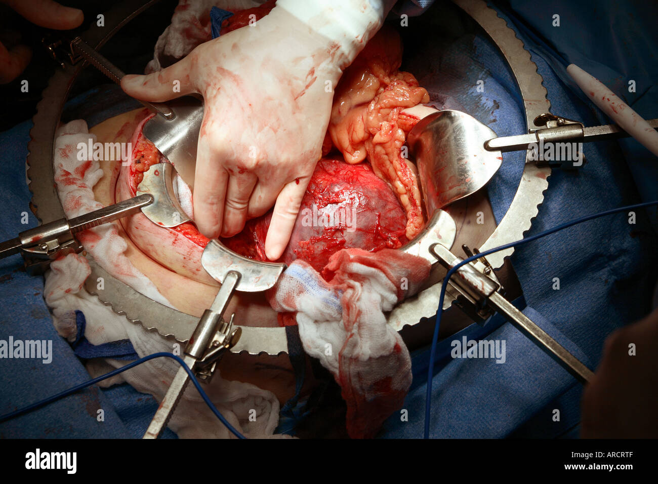 A Bookwalter table fixed retractor in place for exposure during a laparotomy for a large retroperitoneal cyst. Stock Photo