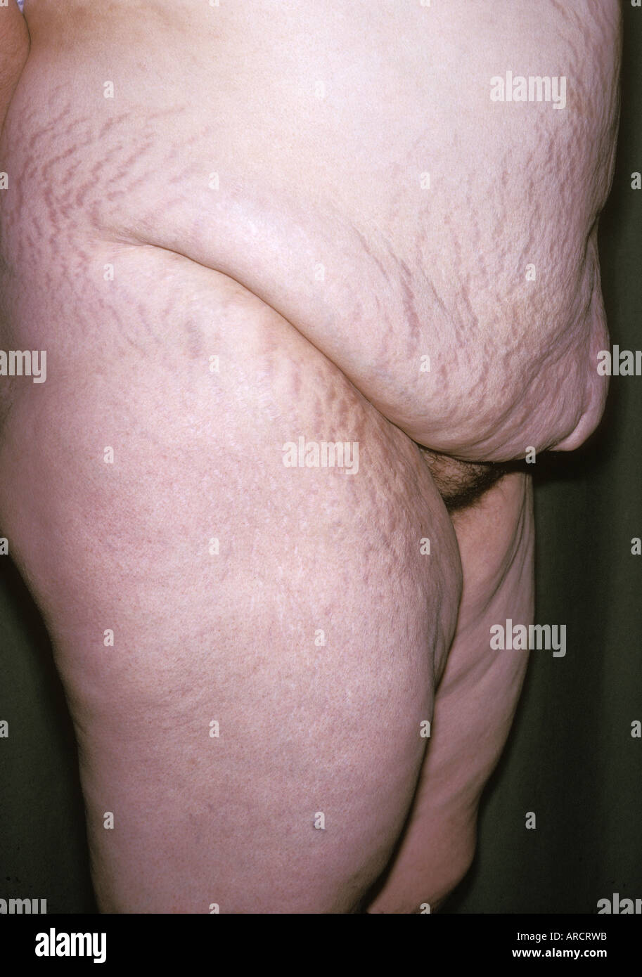 A photograph of an overweight female with lax abdominal muscles and stretchmarks on the abdomen and thighs. Stock Photo