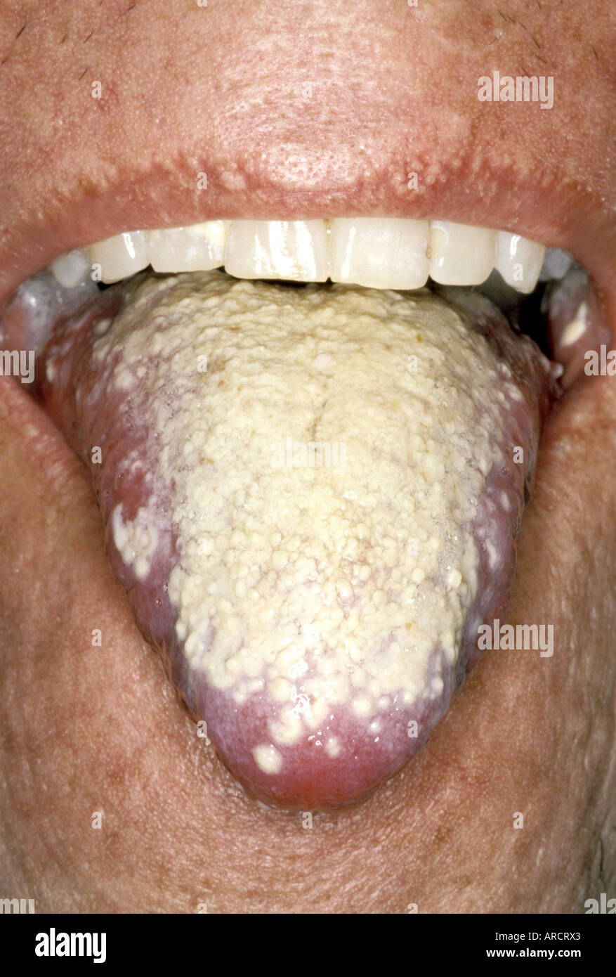Candidiasis is an opportunistic infectious condition caused by a fungi of the genus Candida, predominately Candida albicans. Stock Photo