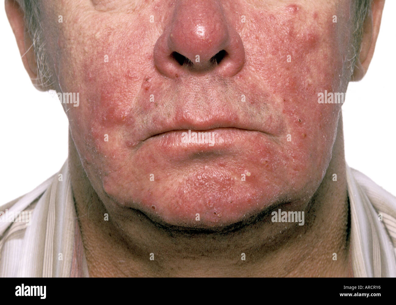 Rosacea is a common inflammatory condition of the skin of the face that  causes redness that looks like a flush or blush Stock Photo - Alamy