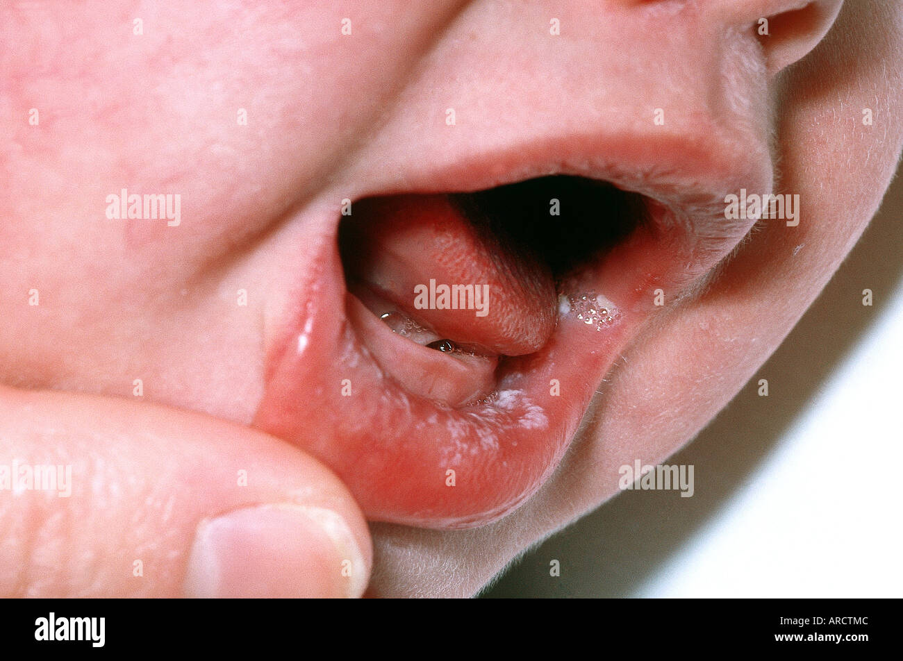 A photograph of a baby with oral thrush, an infection caused by the yeast germ Candida. Stock Photo