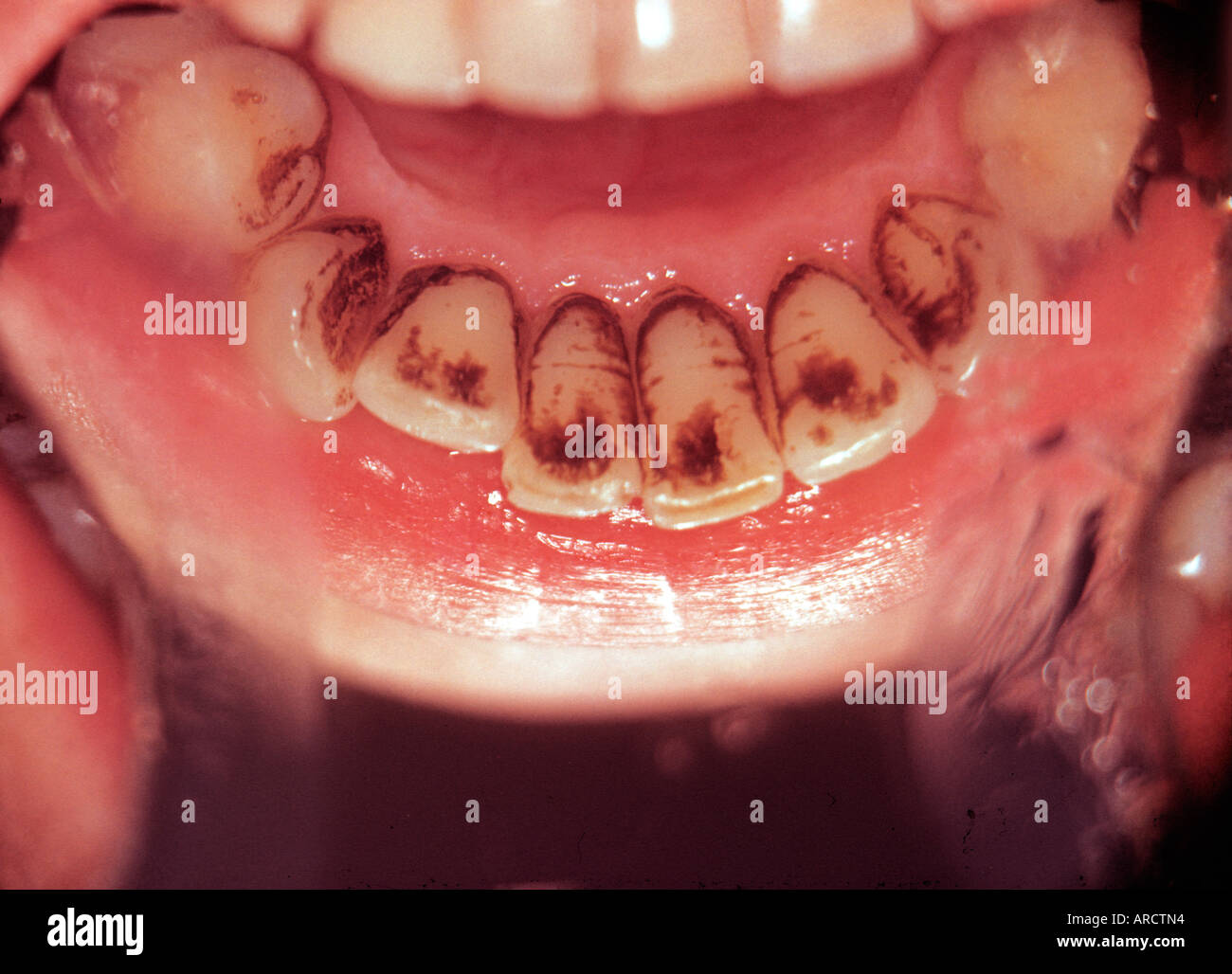 A photograph of tartar and staining on the teeth Stock Photo Alamy