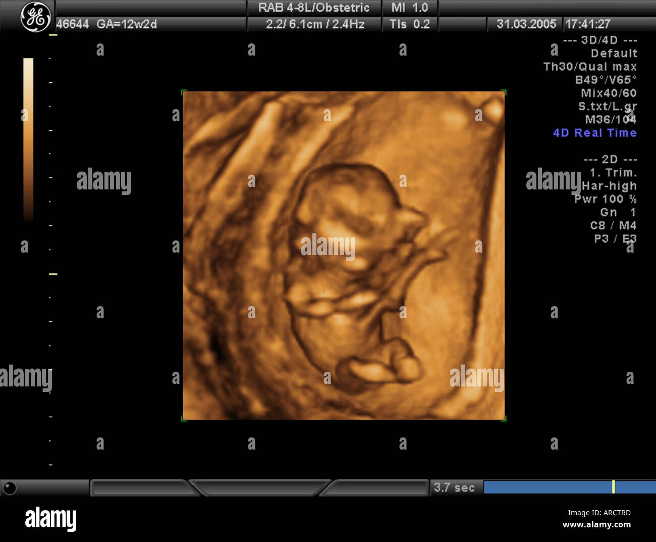 A 3D ultrasound scan of a singleton fetus at 12 weeks gestation Stock