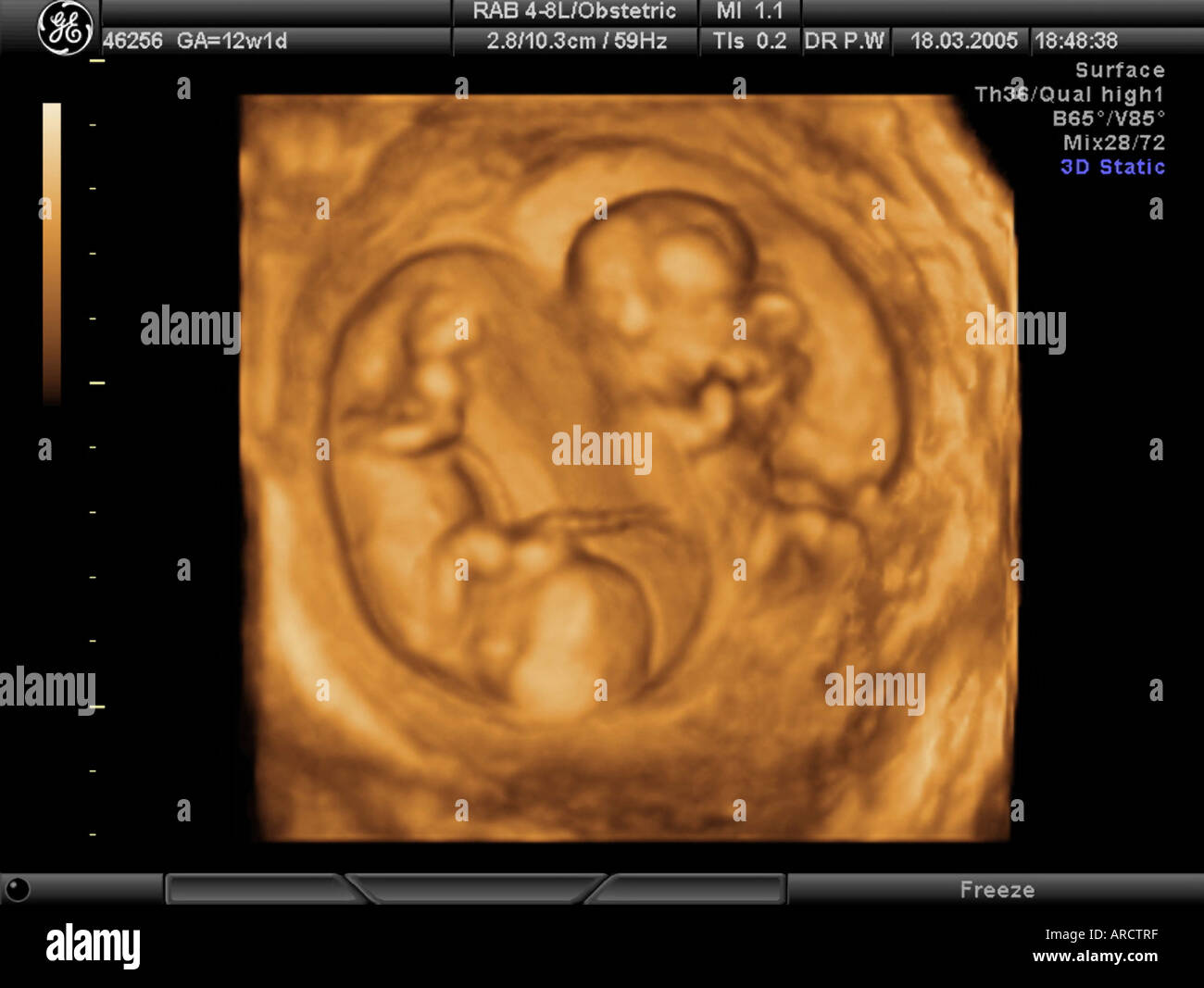 3D ultrasound of a twin pregnancy at 12 weeks Photo - Alamy