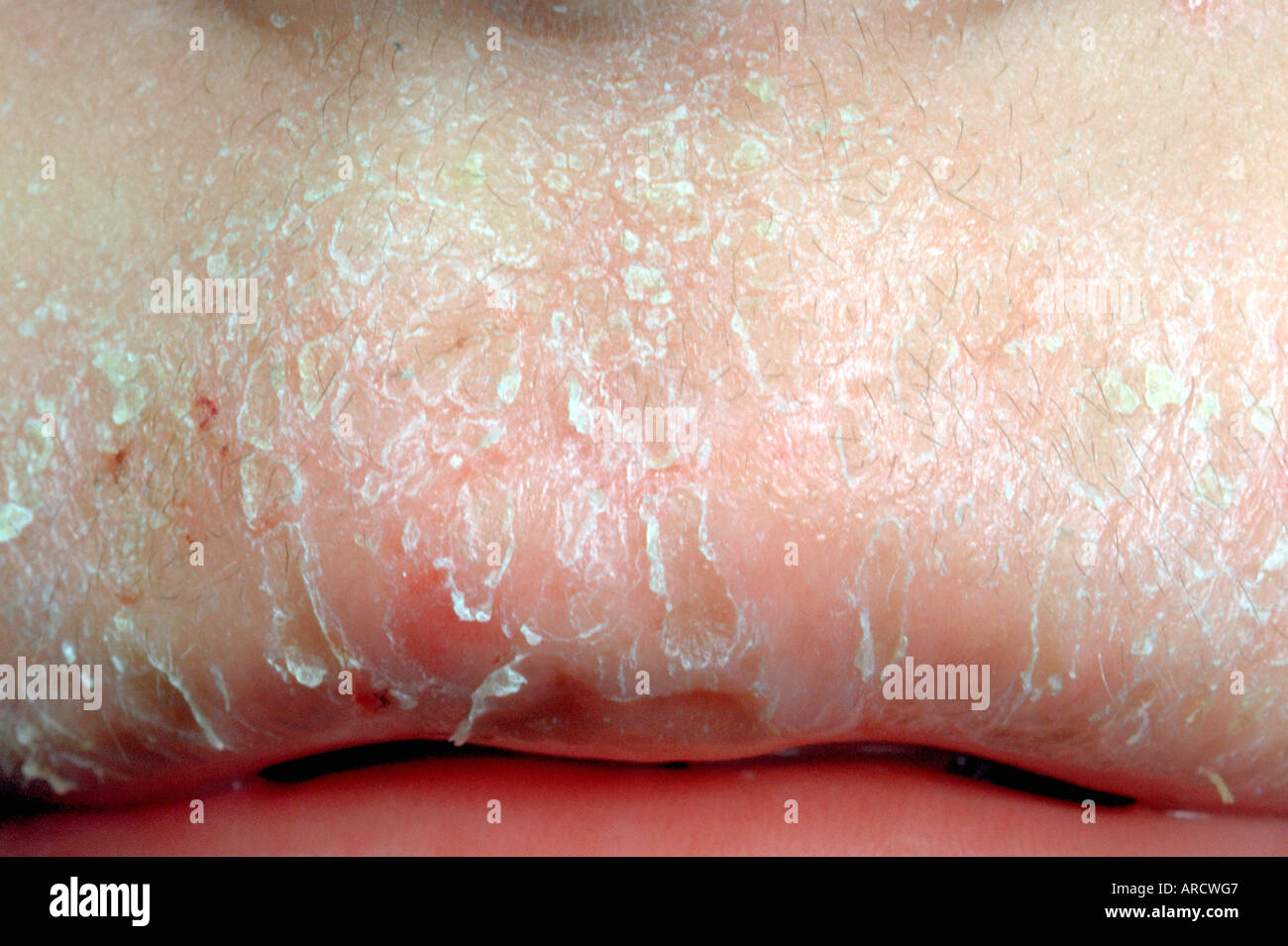 Dermatitis oral hires stock photography and images Alamy