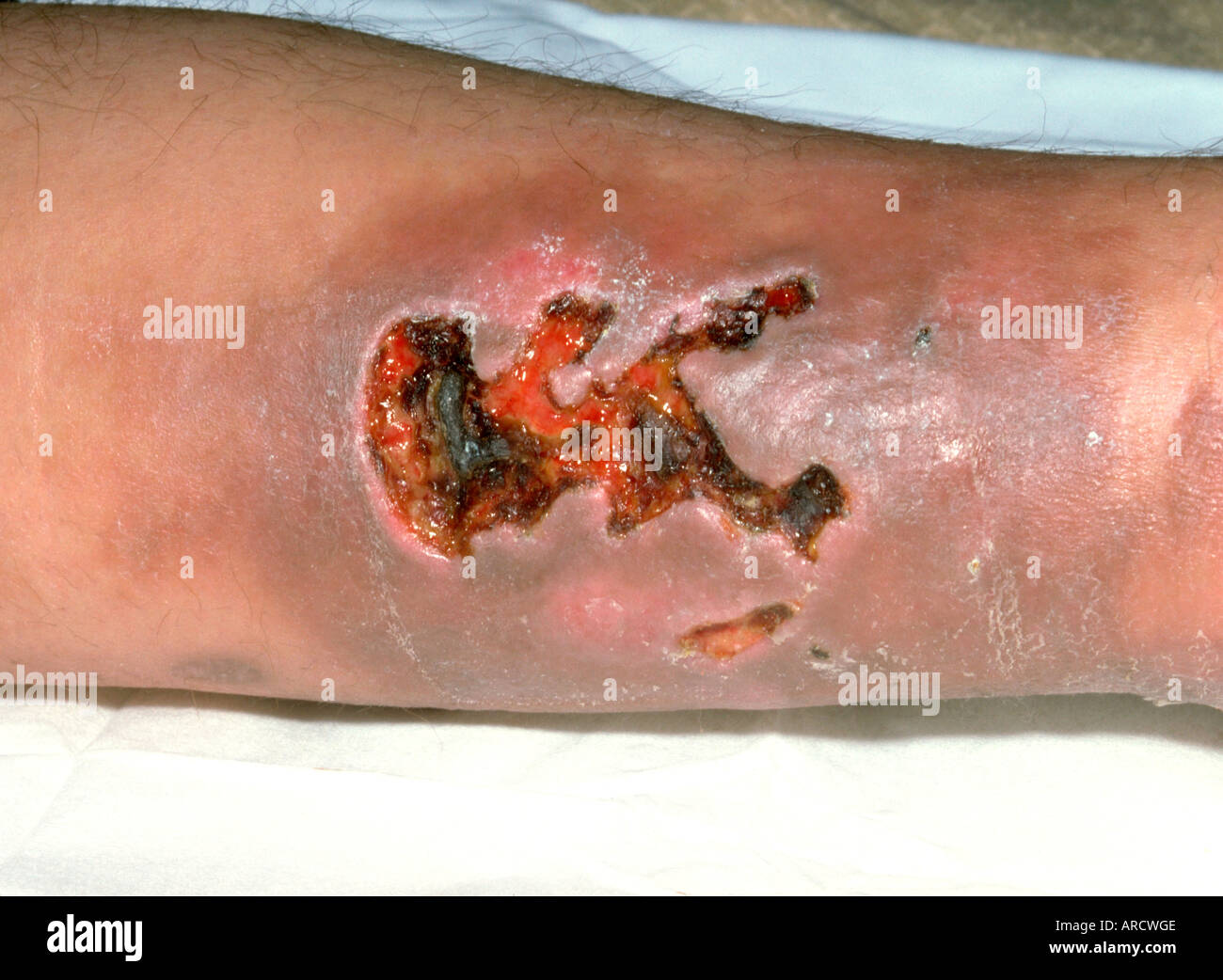 Ulcerated leg Stock Photo