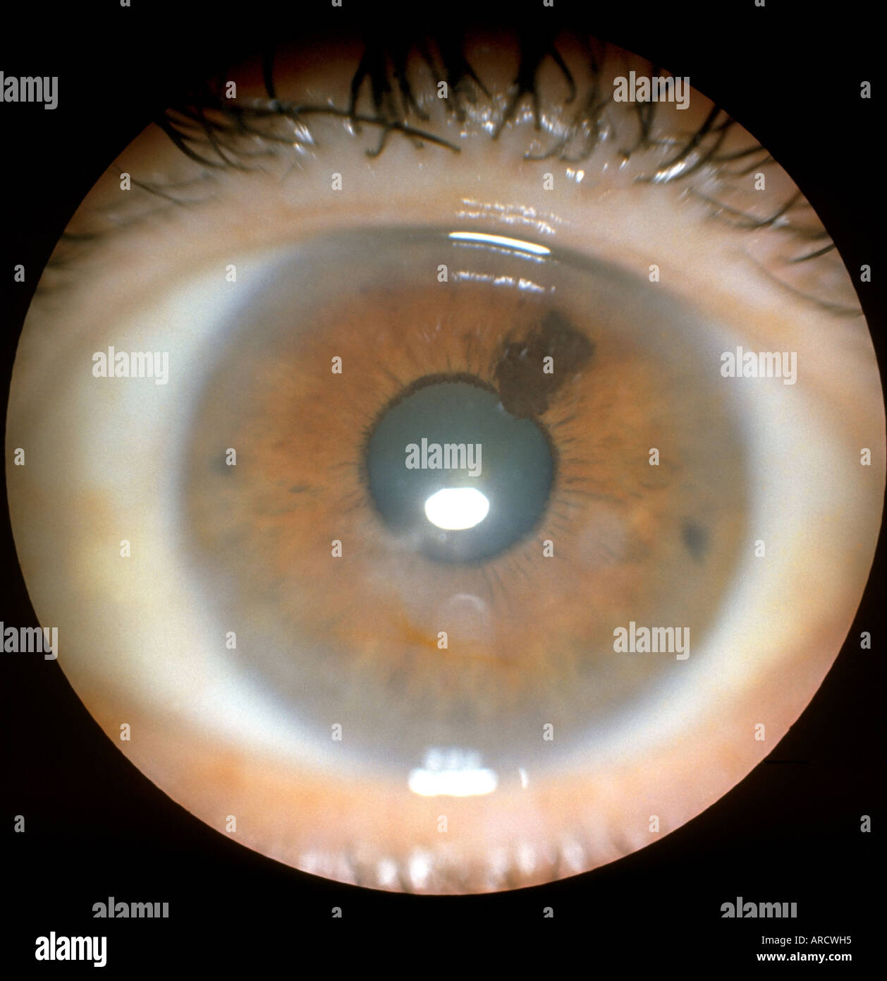 Intraocular melanoma hires stock photography and images Alamy