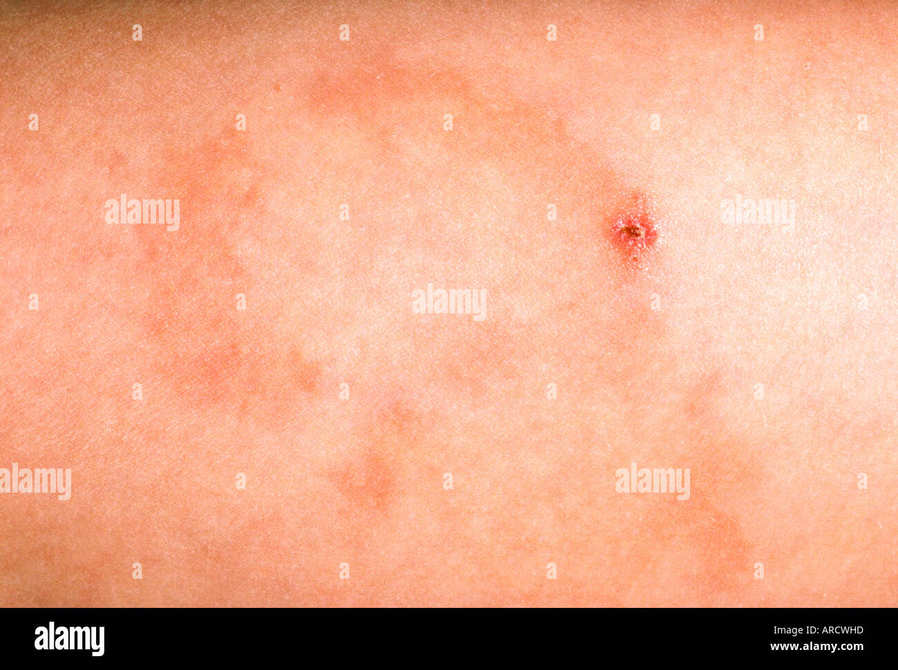 A close up photograph of granuloma annulare, a long-term (chronic Stock ...