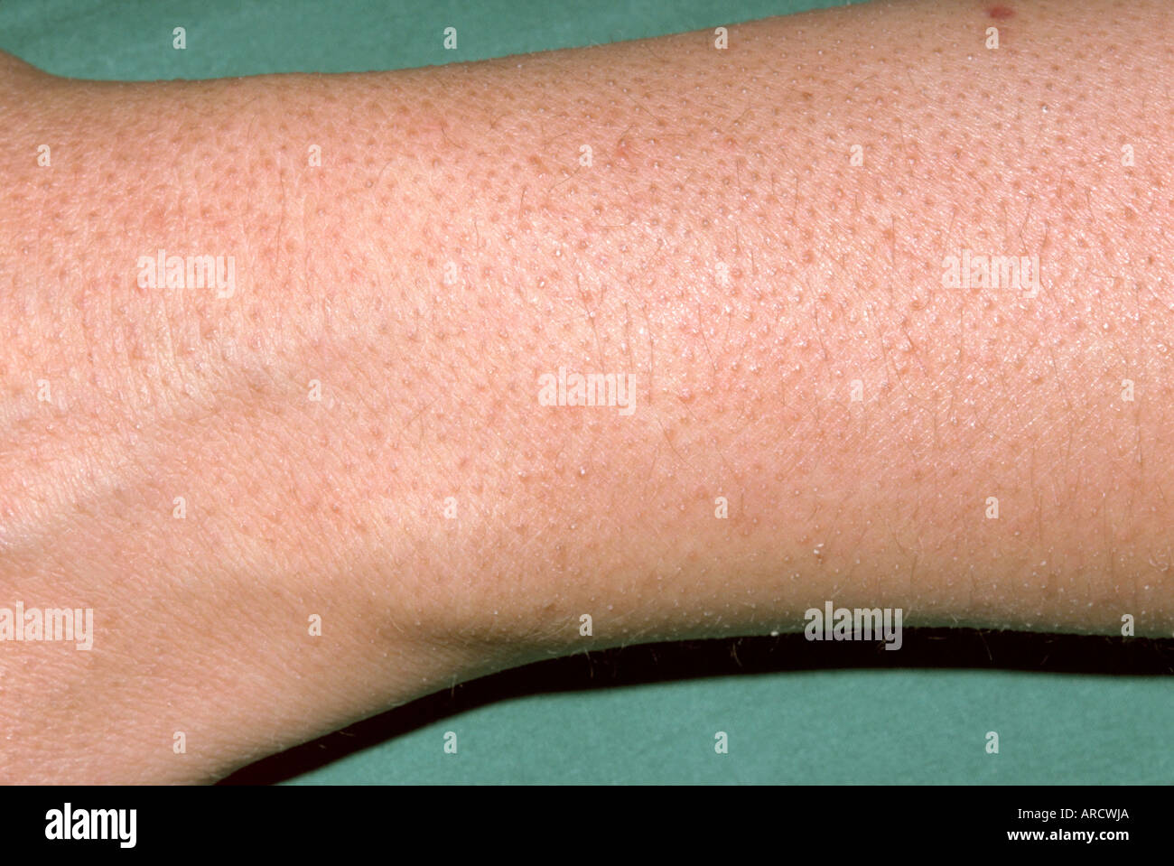 The arm of a patient with keratosis pilaris Stock Photo