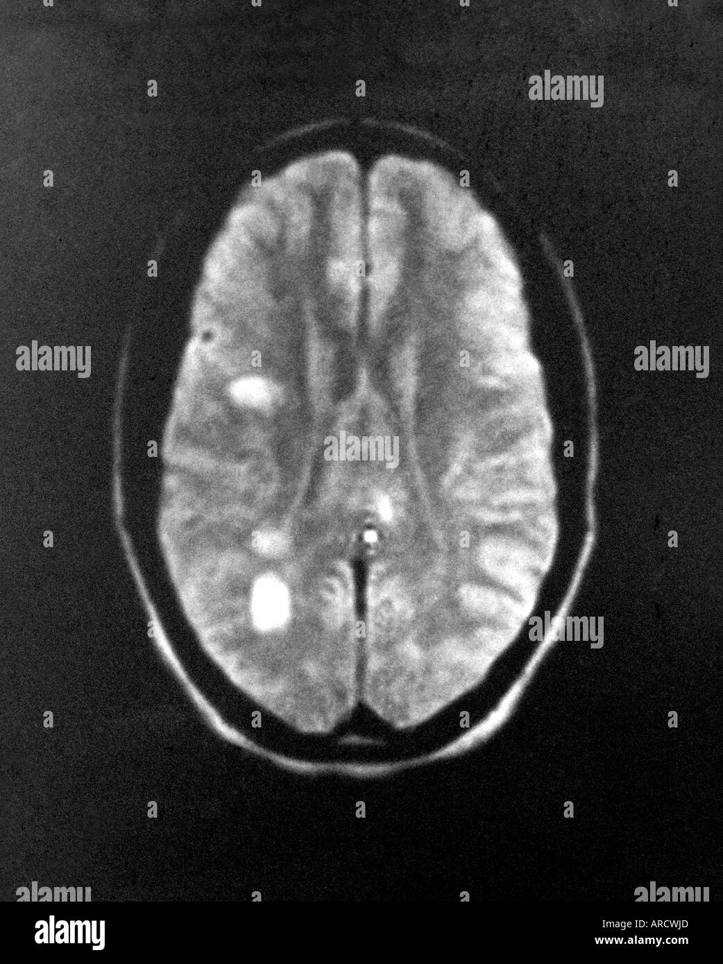 Multiple Sclerosis Mri High Resolution Stock Photography And Images Alamy