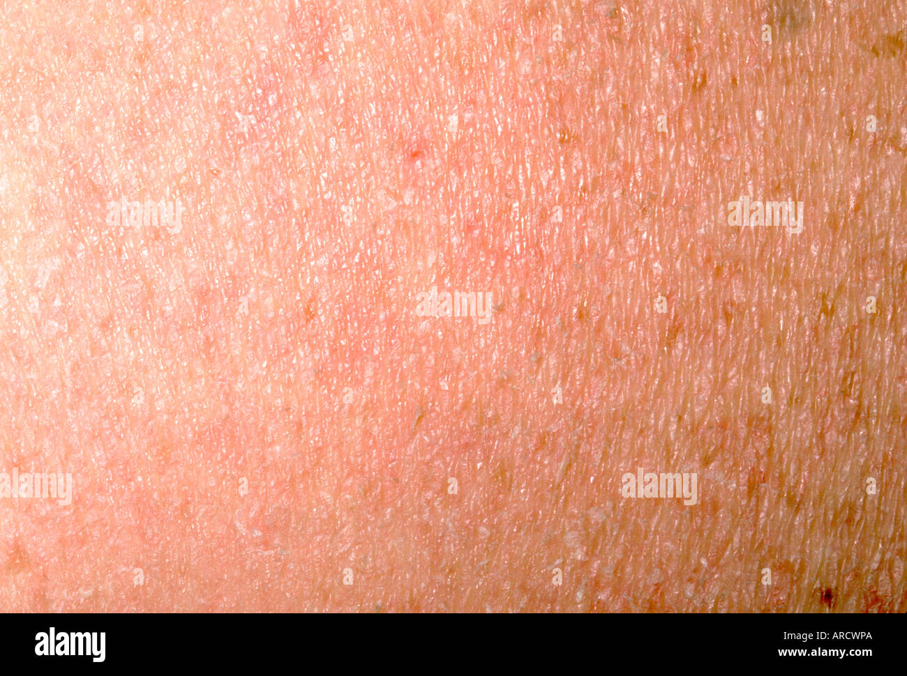 A photograph of eczema in a patient with Kaposi's sarcoma, a malignant tumour of the connective tissue. Stock Photo