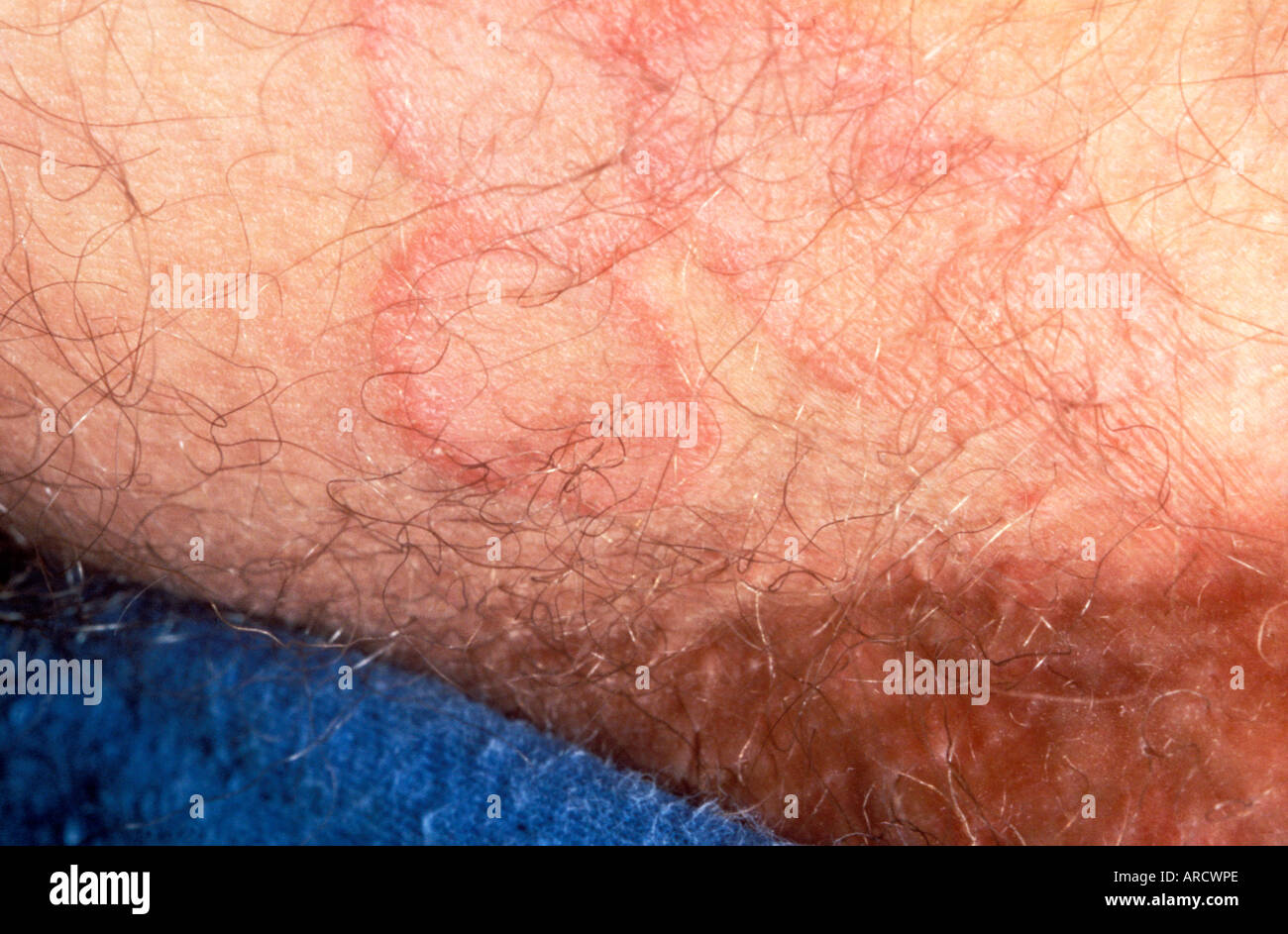 Contrary to its name, ringworm is not caused by a worm. Ringworm is a skin infection caused by a fungus. Stock Photo