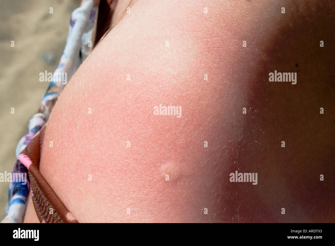Fresh wasp sting on young girl's shoulder. Yes I treated it with anti histamine before I took the shot Stock Photo