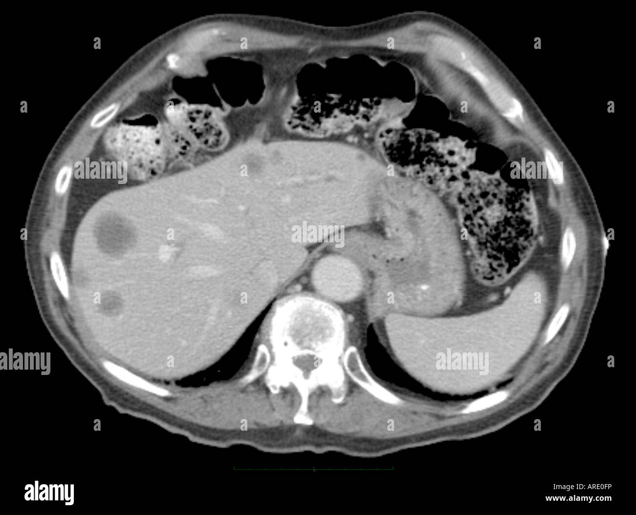 Black Spots On Ct Scan Of Abdomen Splashstory