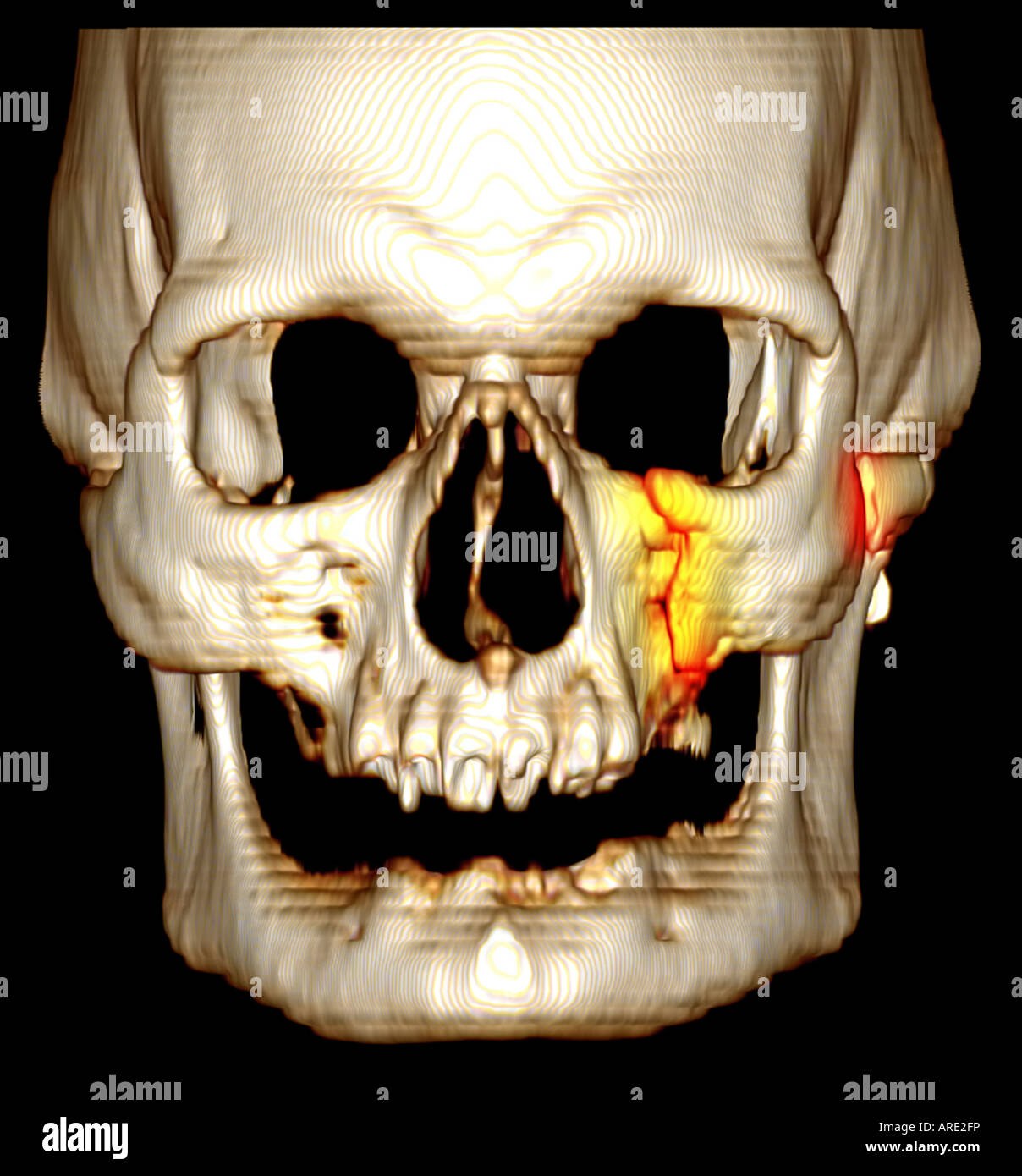 treatment fracture of zygomatic