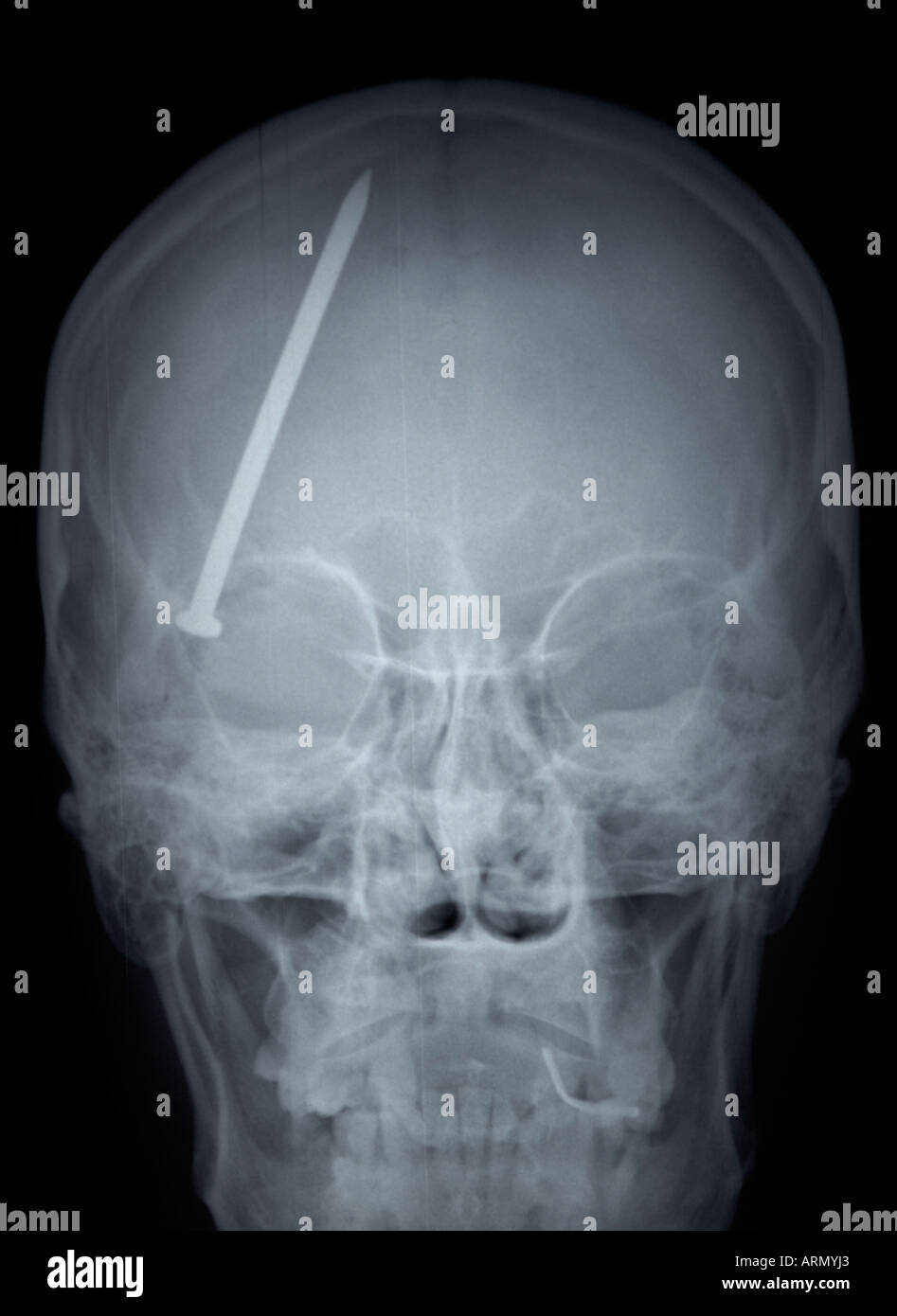 frontal xray of adult skull with nail in head Stock Photo Alamy