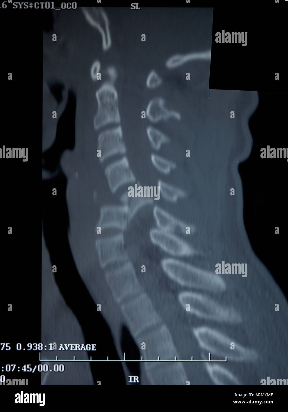 Lateral fractured adult neck Stock Photo