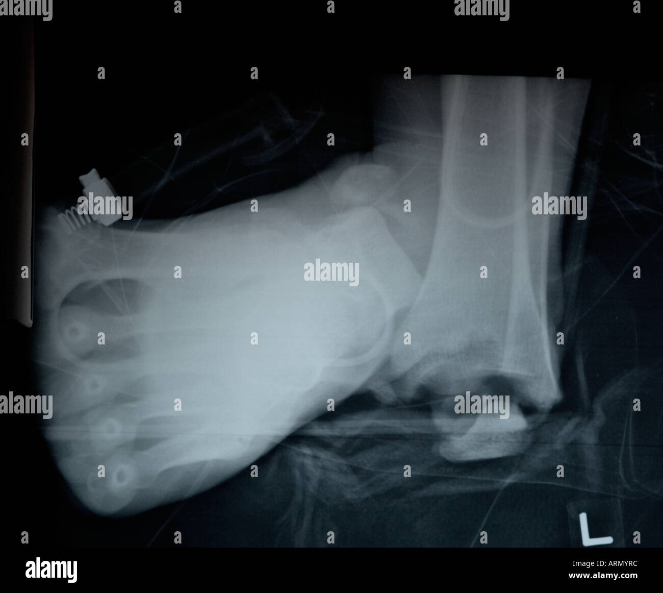 frontal x-ray of adult ankle Stock Photo