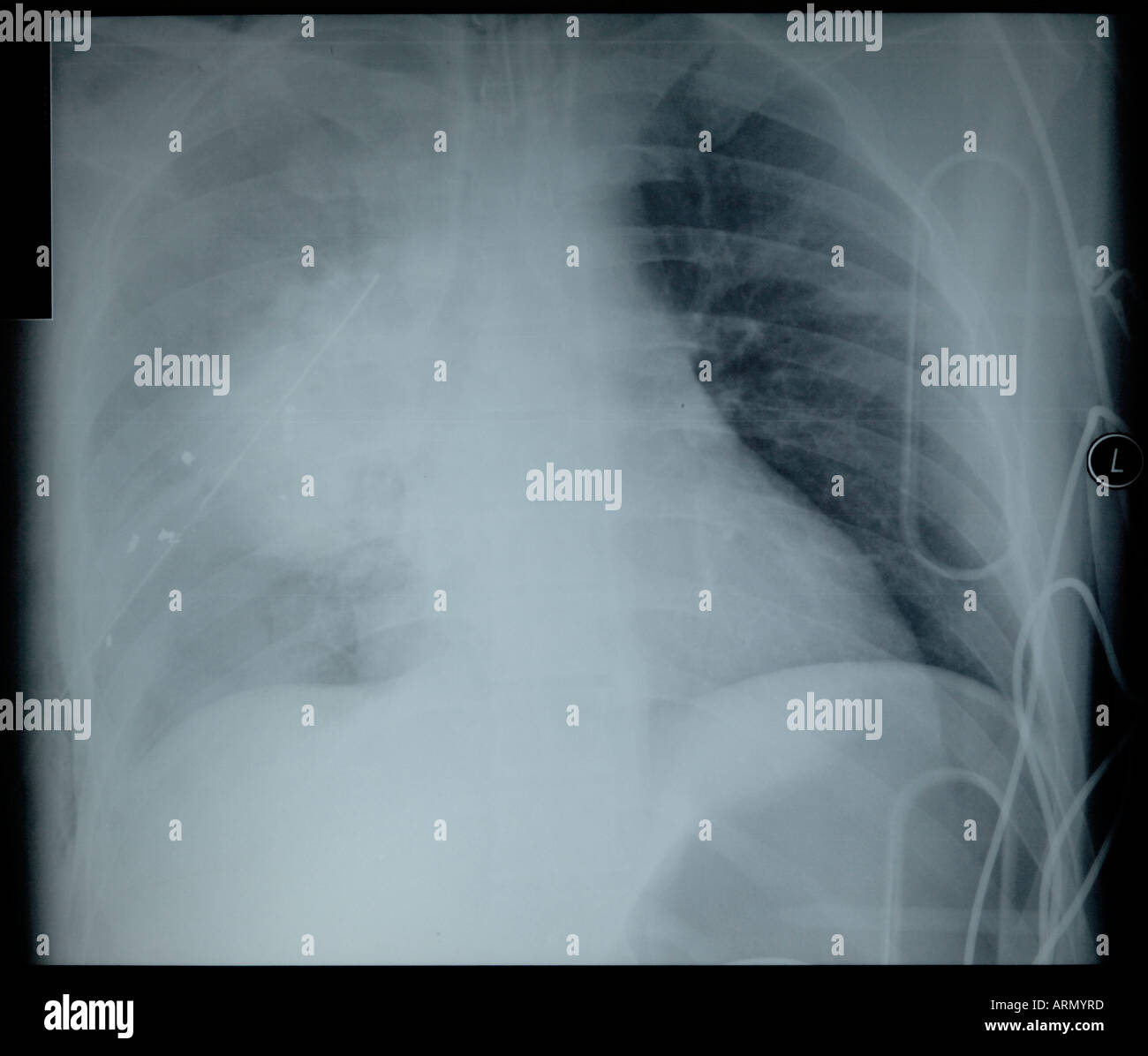 frontal x-ray of gunshot wound to right lung Stock Photo