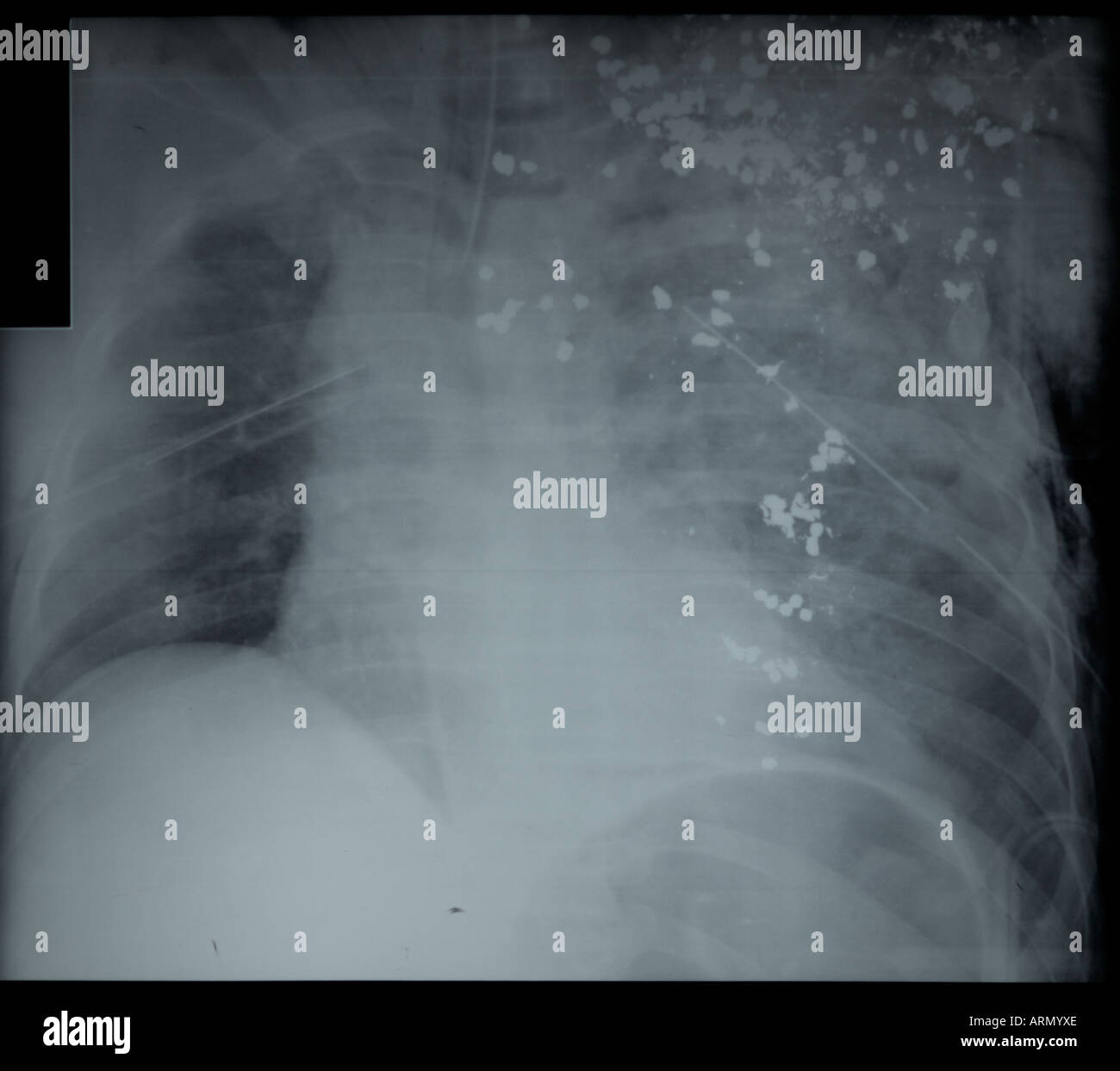 Shotgun Birdshot Wound