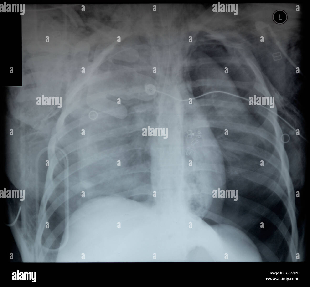 frontal x-ray of fatal blunt chest trauma Stock Photo