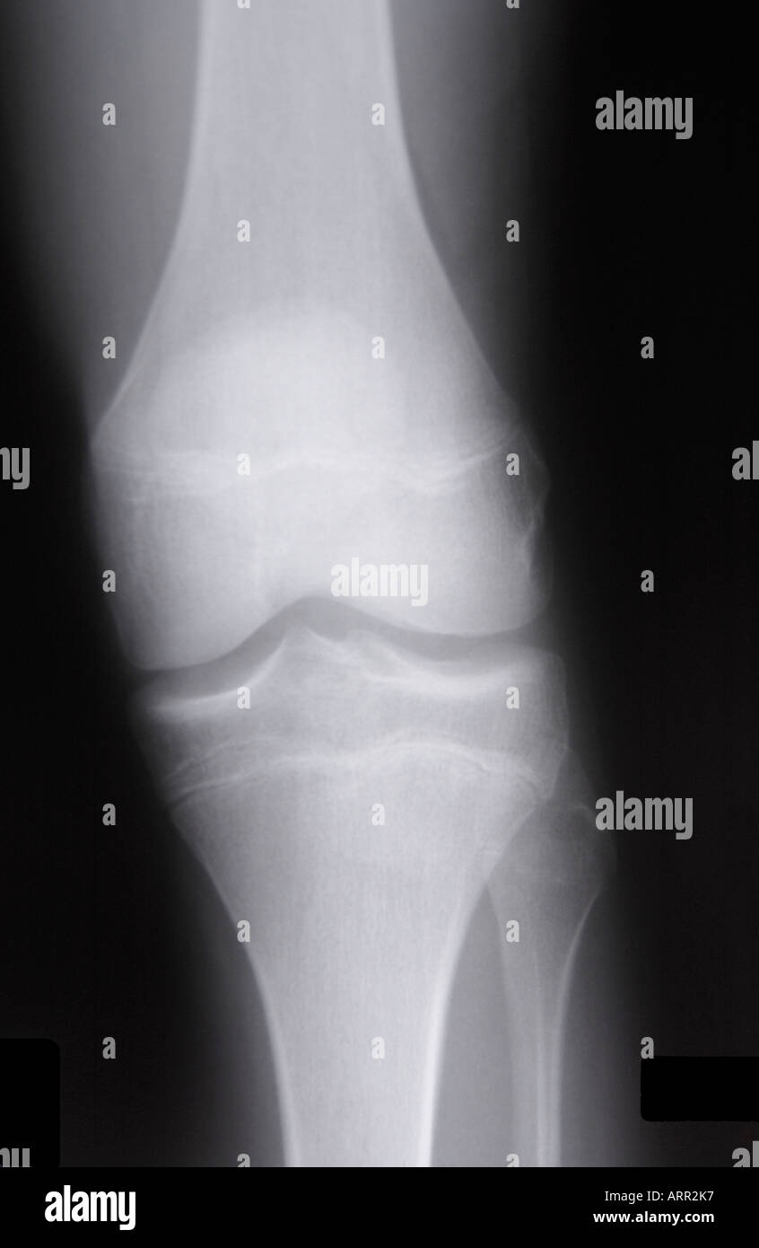 normal frontal x-ray of juvenile knee Stock Photo