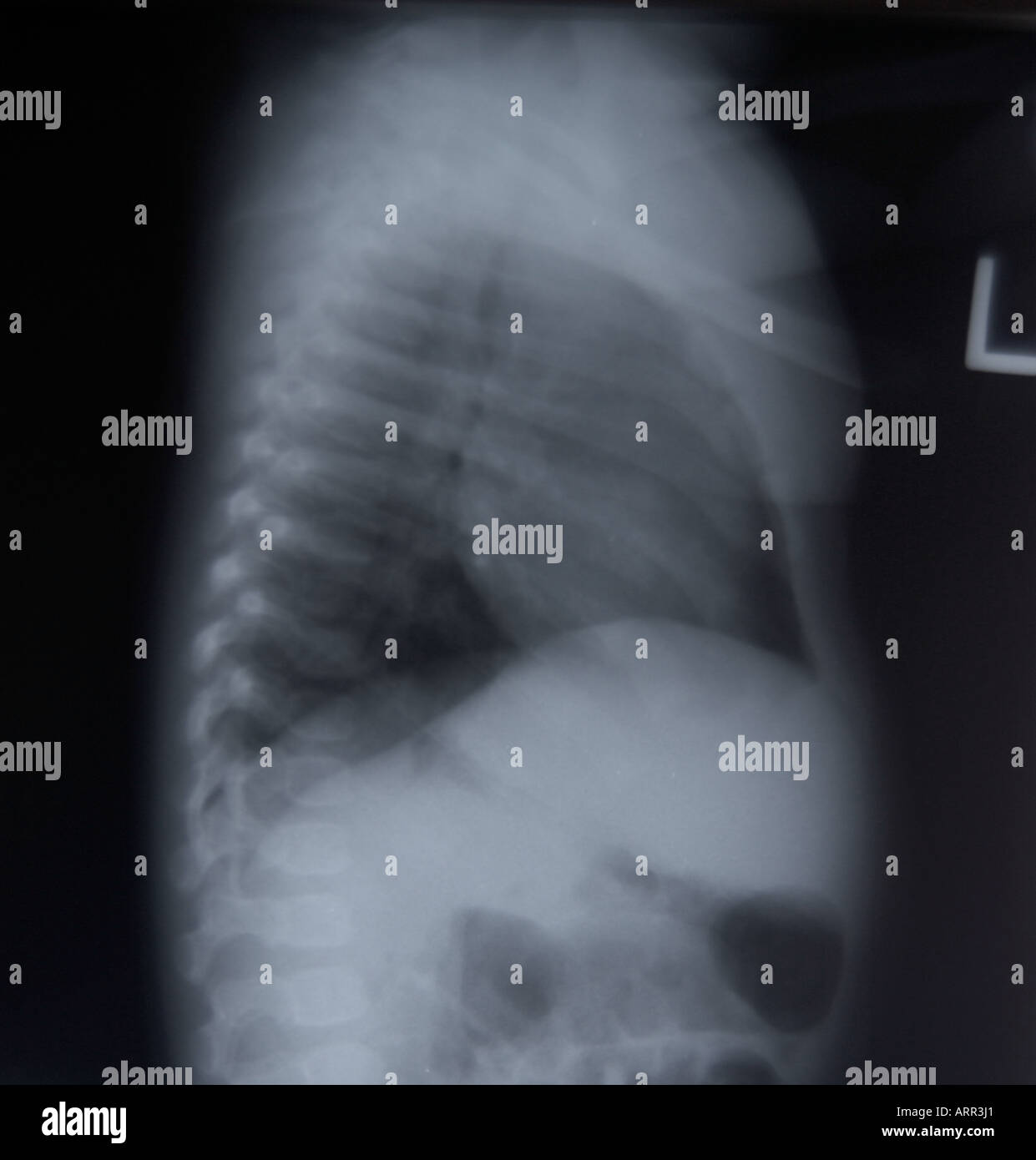 Normal Pediatric Chest X Ray