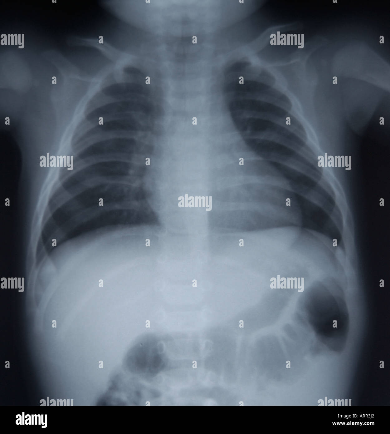 frontal view of normal pediatric chest xray Stock Photo Alamy