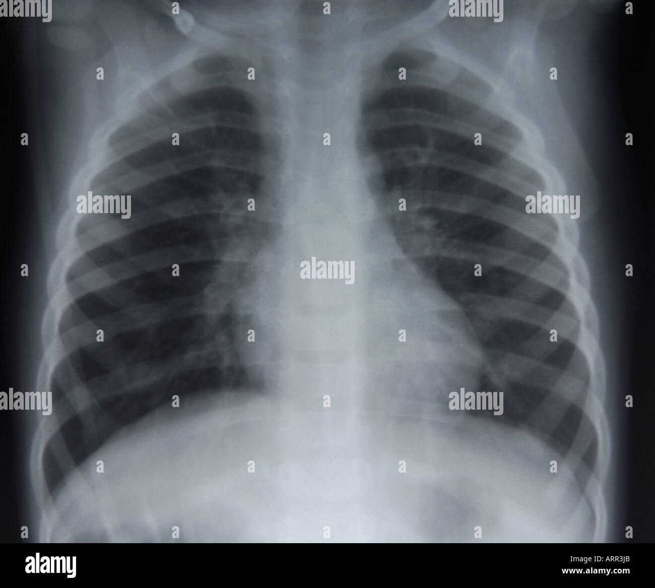 Frontal view of pediatric chest x ray stock photo 9206122 alamy