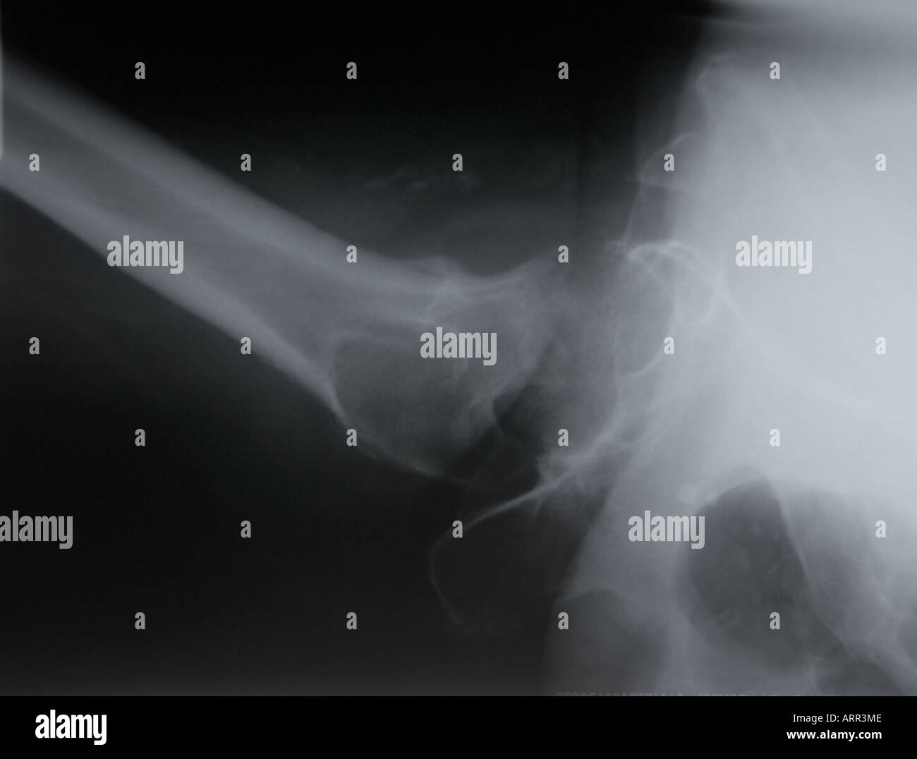 cross table lateral xray of elderly hip fracture Stock Photo Alamy