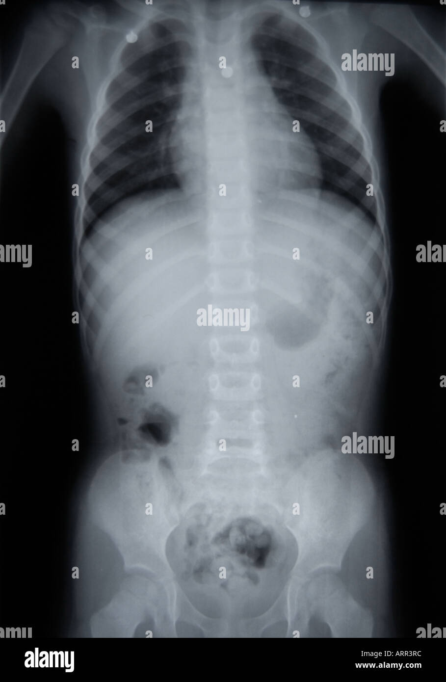 Normal abdominal x ray