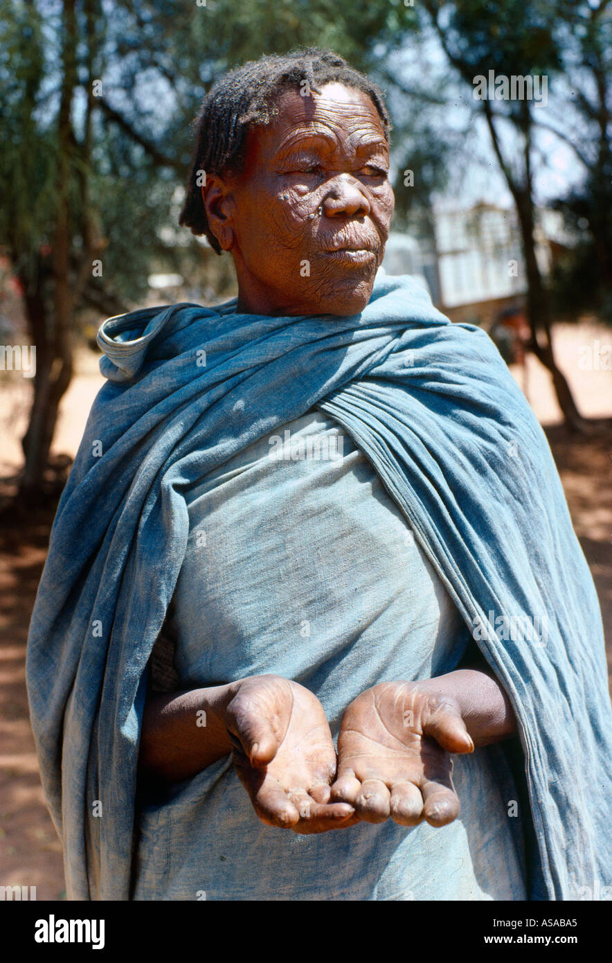 Sudan Woman With Leprosy Showing Hands Stock Photo