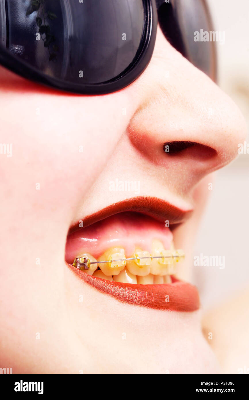 young womans mouth with braces Stock Photo Alamy