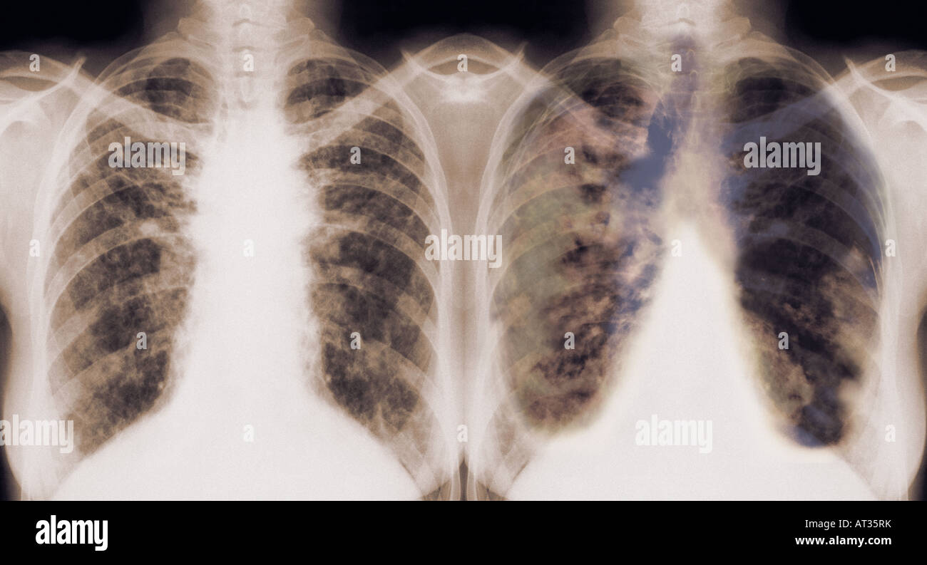 Xrays of human lungs, healthy and diseased Stock Photo Alamy