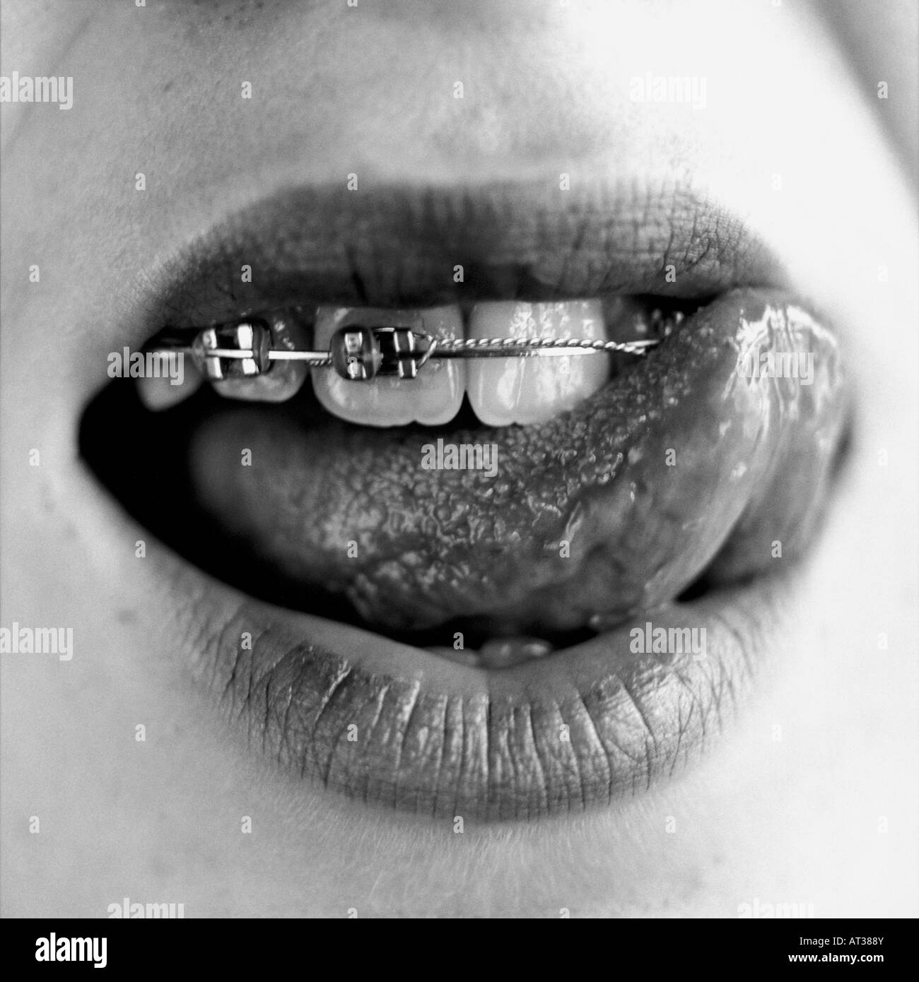 Corrective braces Black and White Stock Photos & Images Alamy