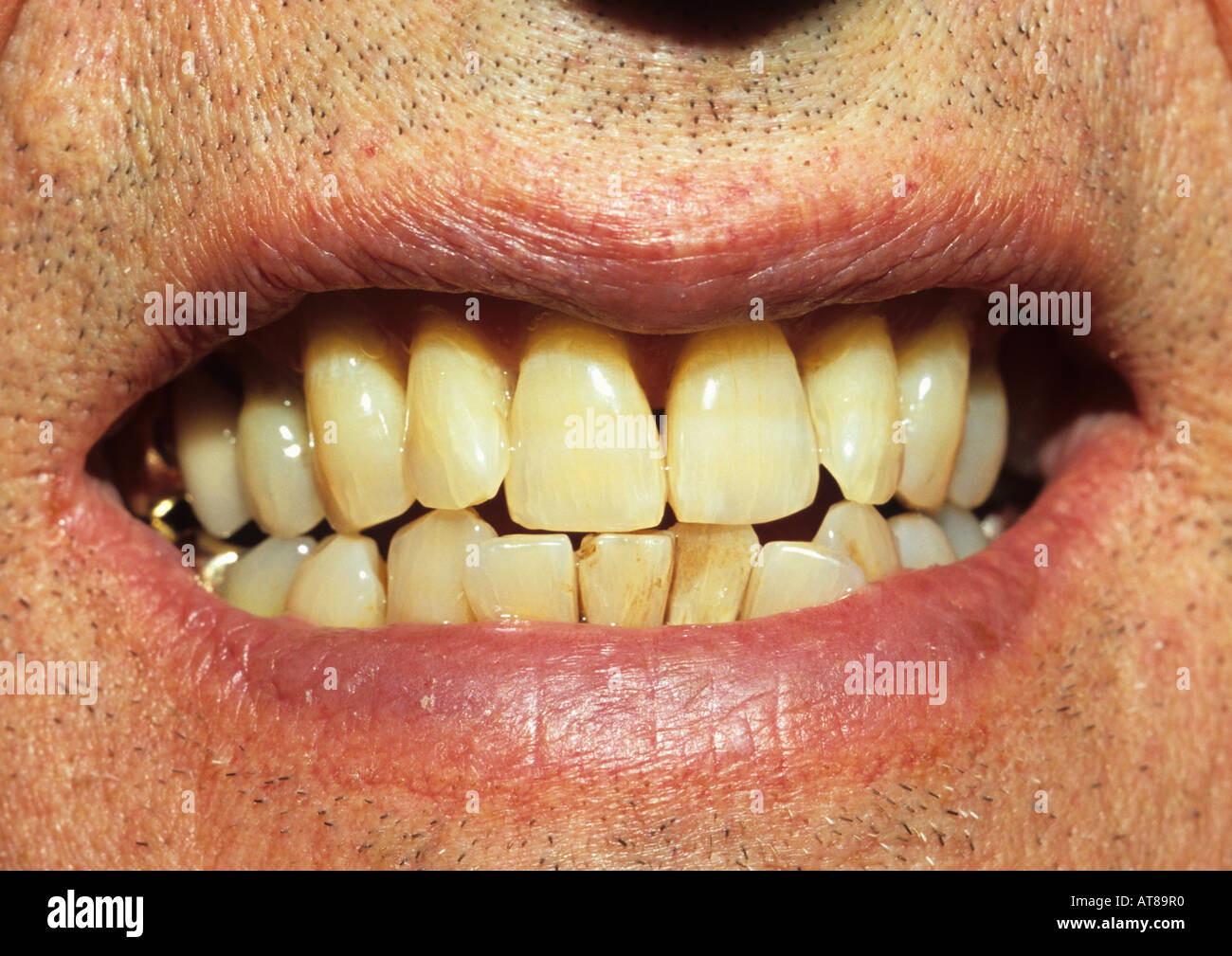 yellowest teeth in the world