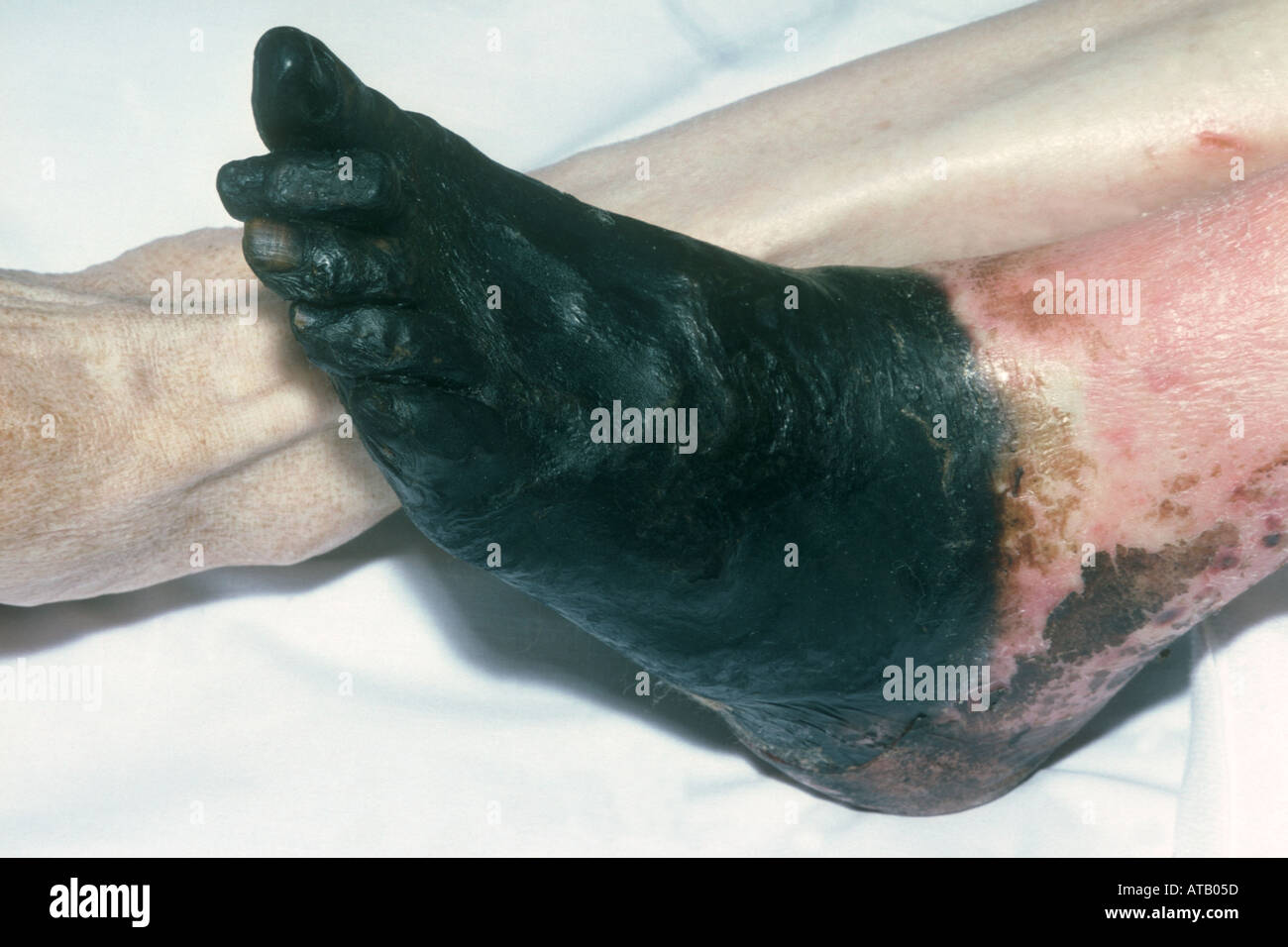 Gangrene left foot Stock Photo