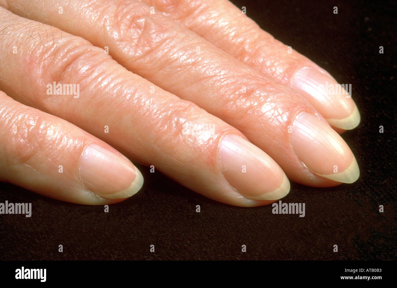 Finger Clubbing Stock Photo Alamy