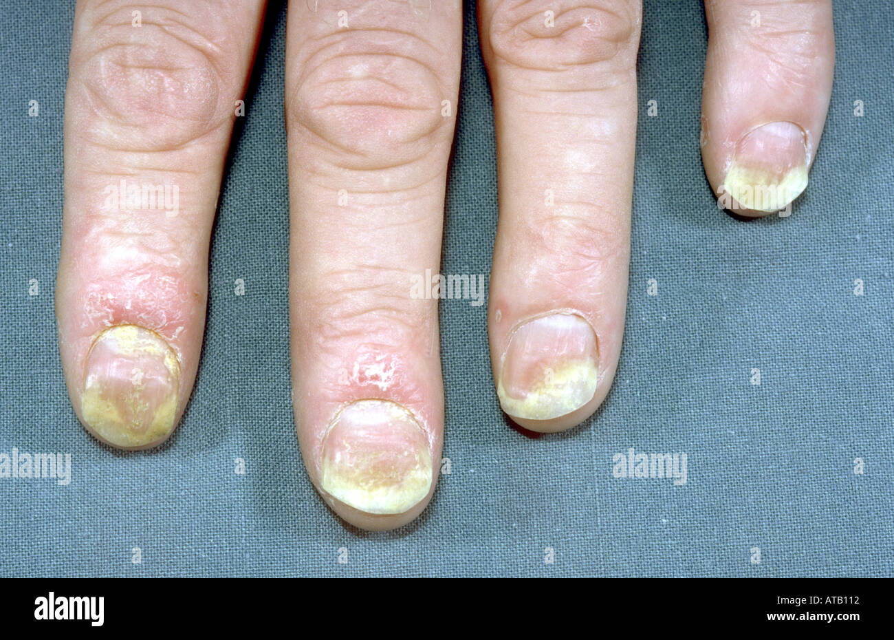 Toe Nail Psoriasis Image & Photo (Free Trial) | Bigstock