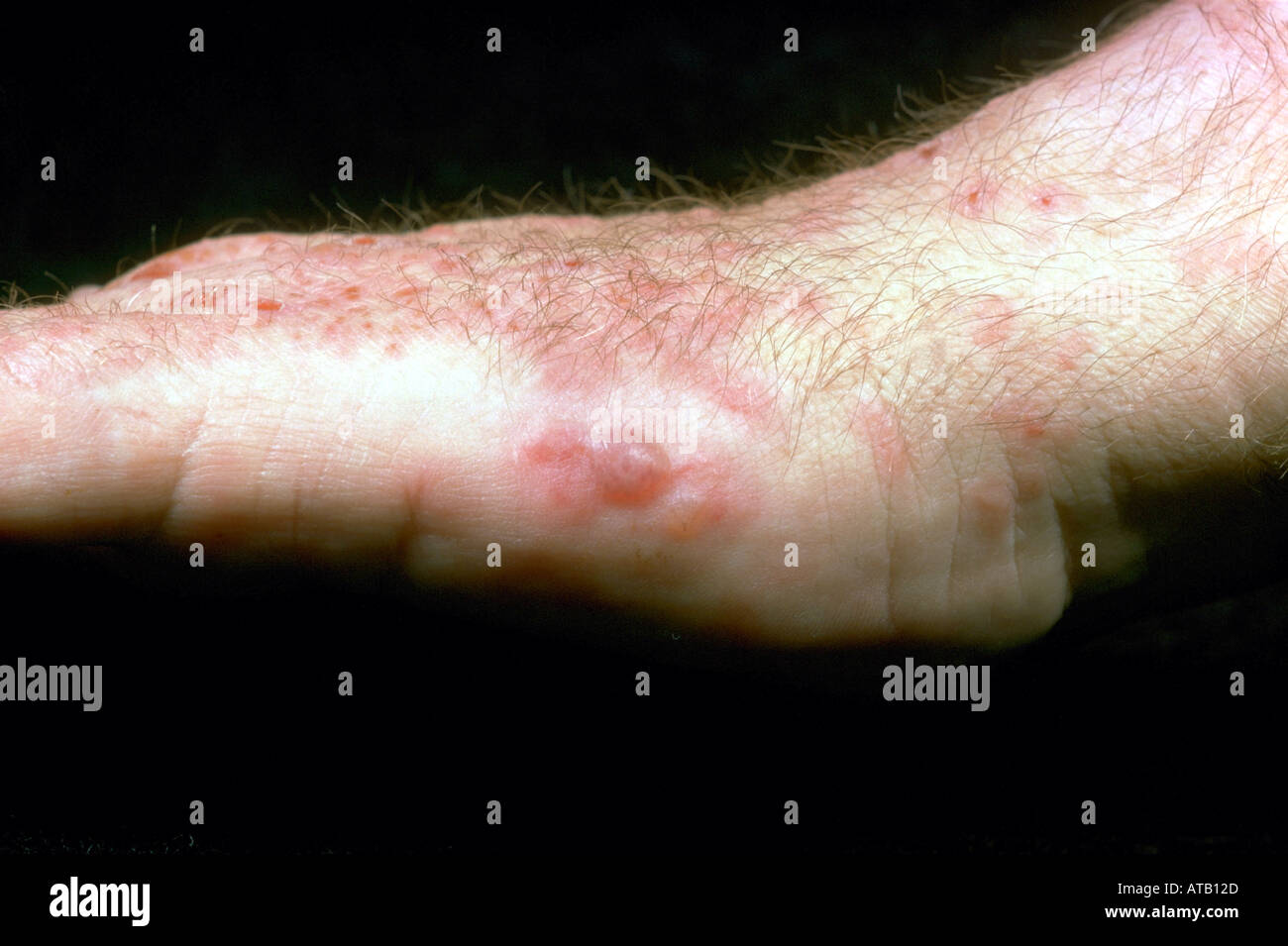 Dermatitis herpetiformis Stock Photo